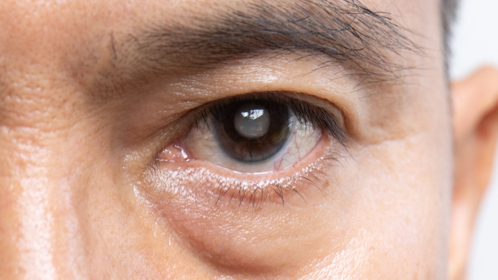 A detailed close-up of a human eye, with the iris and pupil prominently featured. The lens of the eye appears cloudy and opaque, indicating the presence of cataracts. The image is captured in a clinical, well-lit setting, showcasing the lens in a clear and focused manner. The depth of field is shallow, keeping the surrounding areas slightly blurred to emphasize the cataract. The lighting is soft and diffused, creating a clean, professional atmosphere. The perspective is slightly angled, providing a dynamic and informative view of the eye condition. Cataract Symptoms 01