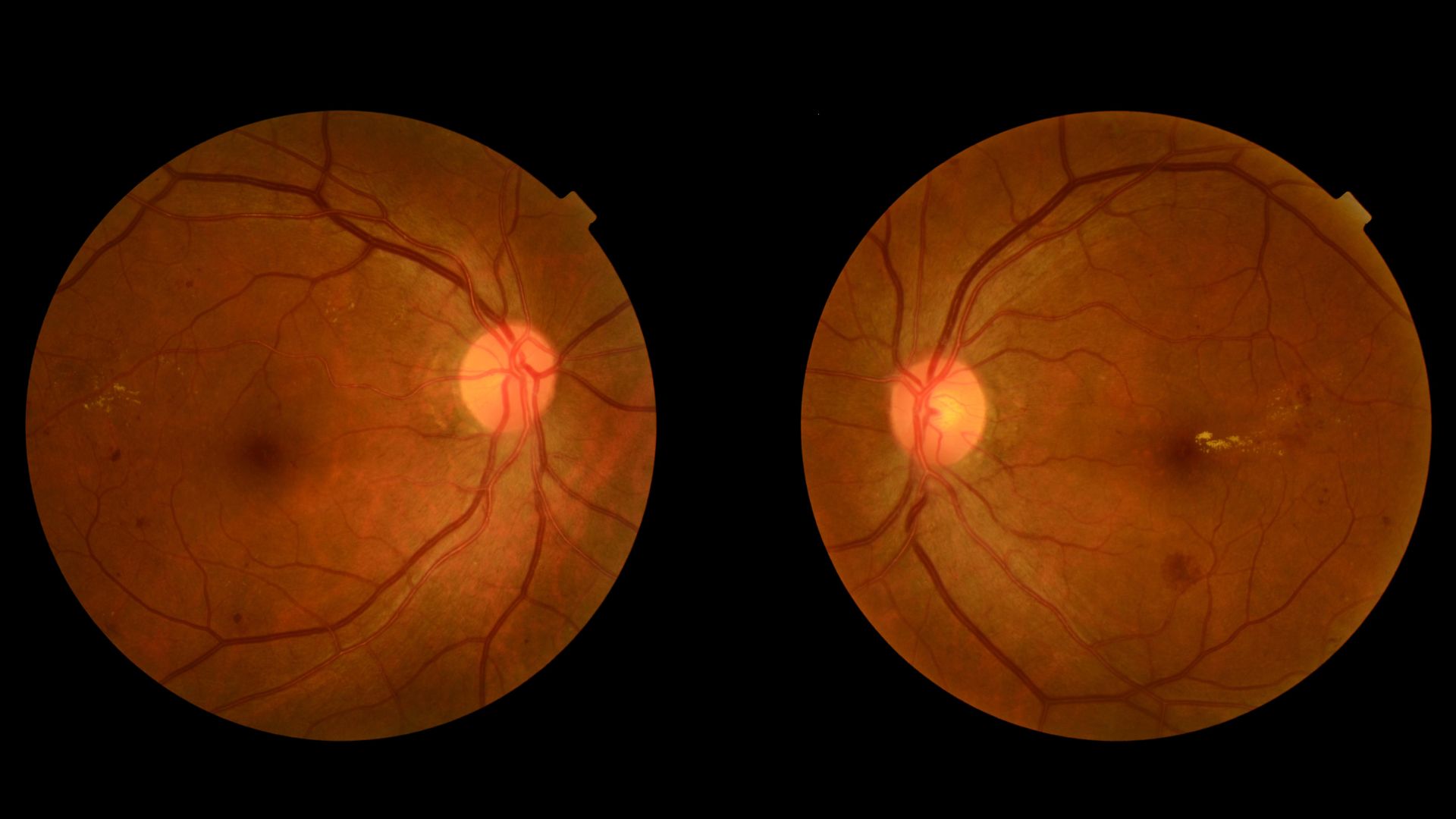 Detailed cross-section of the eye, focusing on the retina and its structural components. Vibrant colors and subtle textures to depict the delicate layers, including the photoreceptor cells, retinal pigment epithelium, and choroid. Dramatic lighting accentuates the retinal detachment, showcasing the separation of the retina from the underlying tissues. Technical precision with a slight sense of unease, conveying the seriousness of the condition. Crisp, high-resolution rendering to ensure clarity and visual impact for the medical article. Retinal Detachment Warning Signs 3