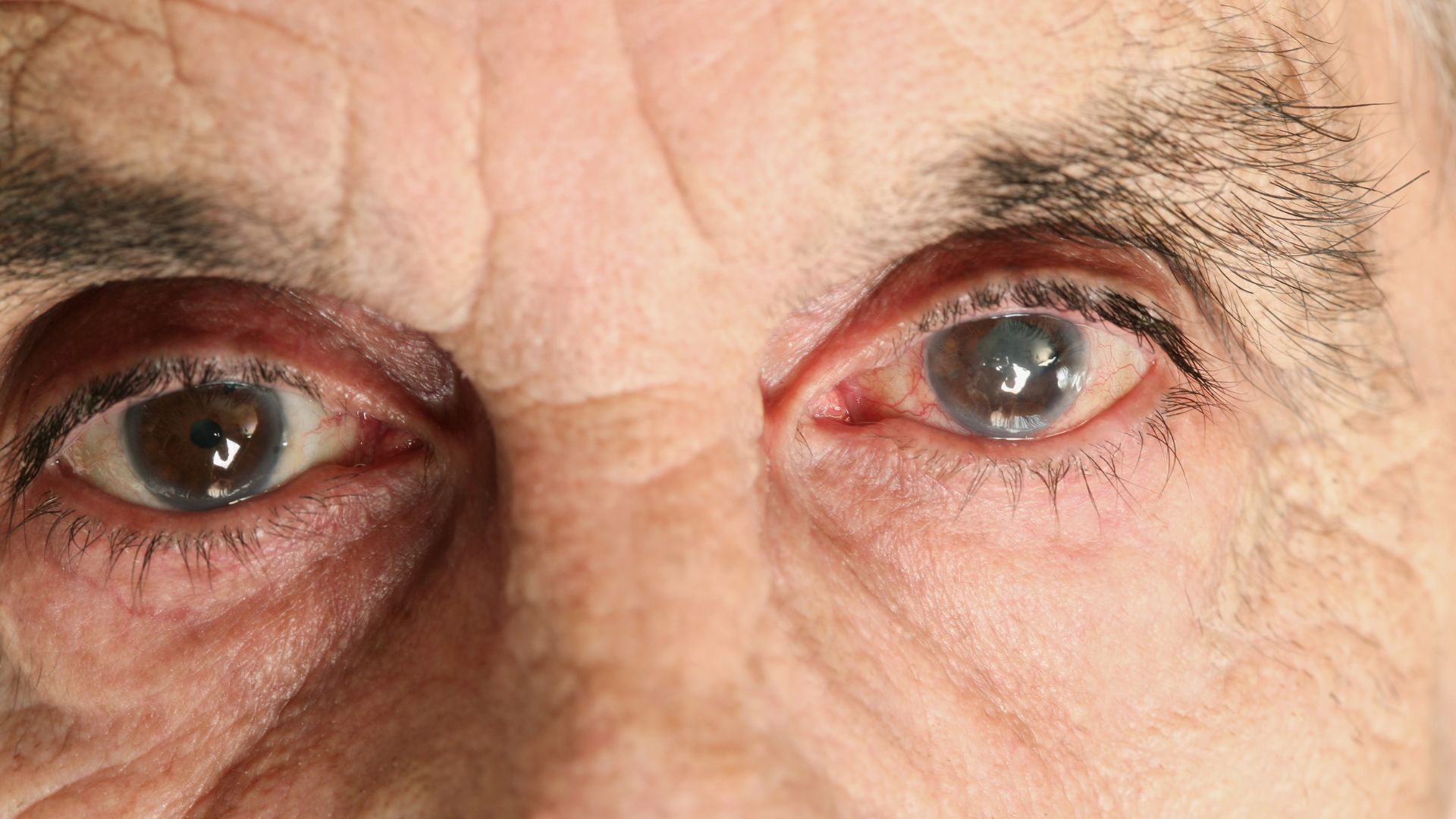 A detailed illustration depicting the symptoms of glaucoma. In the foreground, a close-up view of a human eye, showcasing the characteristic optic nerve damage and increased intraocular pressure associated with the condition. The middle ground features a cross-sectional diagram of the eye, highlighting the anatomical changes that occur. In the background, a muted color palette evokes a sense of seriousness and medical urgency. Soft, directional lighting casts subtle shadows, emphasizing the three-dimensional nature of the imagery. The overall composition conveys a sense of scientific accuracy and visual clarity, effectively communicating the importance of early detection and treatment of glaucoma. understanding glaucoma 01